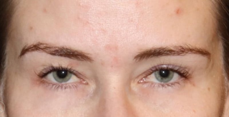 Eyelid Surgery Before & After Gallery - Patient 327447 - Image 1
