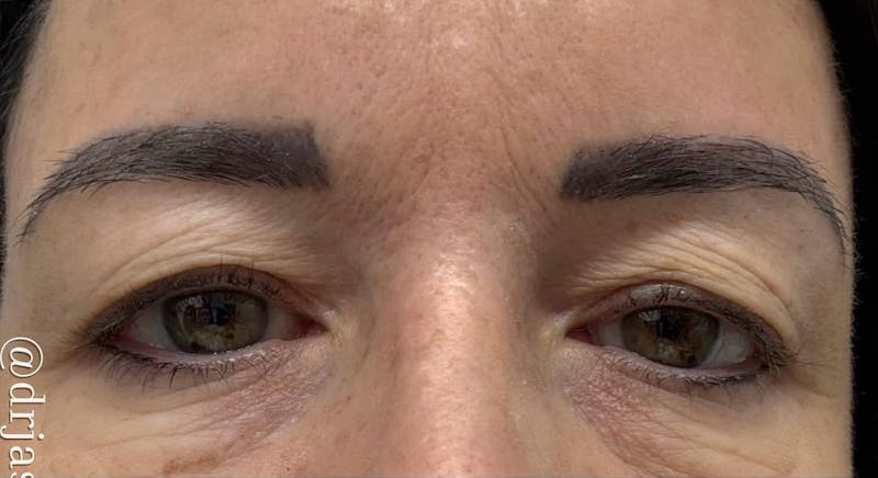 Eyelid Surgery Before & After Gallery - Patient 159271 - Image 1