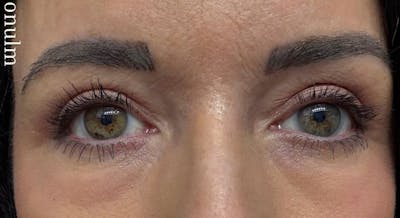 Eyelid Surgery Before & After Gallery - Patient 159271 - Image 2