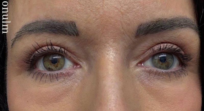 Eyelid Surgery Before & After Gallery - Patient 159271 - Image 2