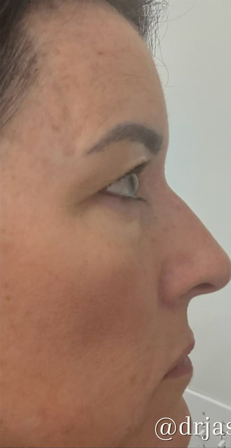 Eyelid Surgery Before & After Gallery - Patient 159271 - Image 3