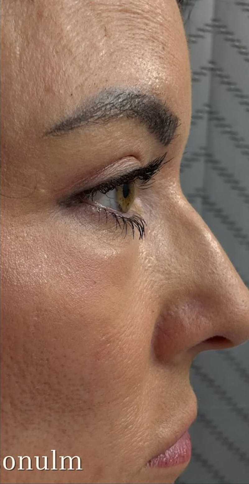 Eyelid Surgery Before & After Gallery - Patient 159271 - Image 4
