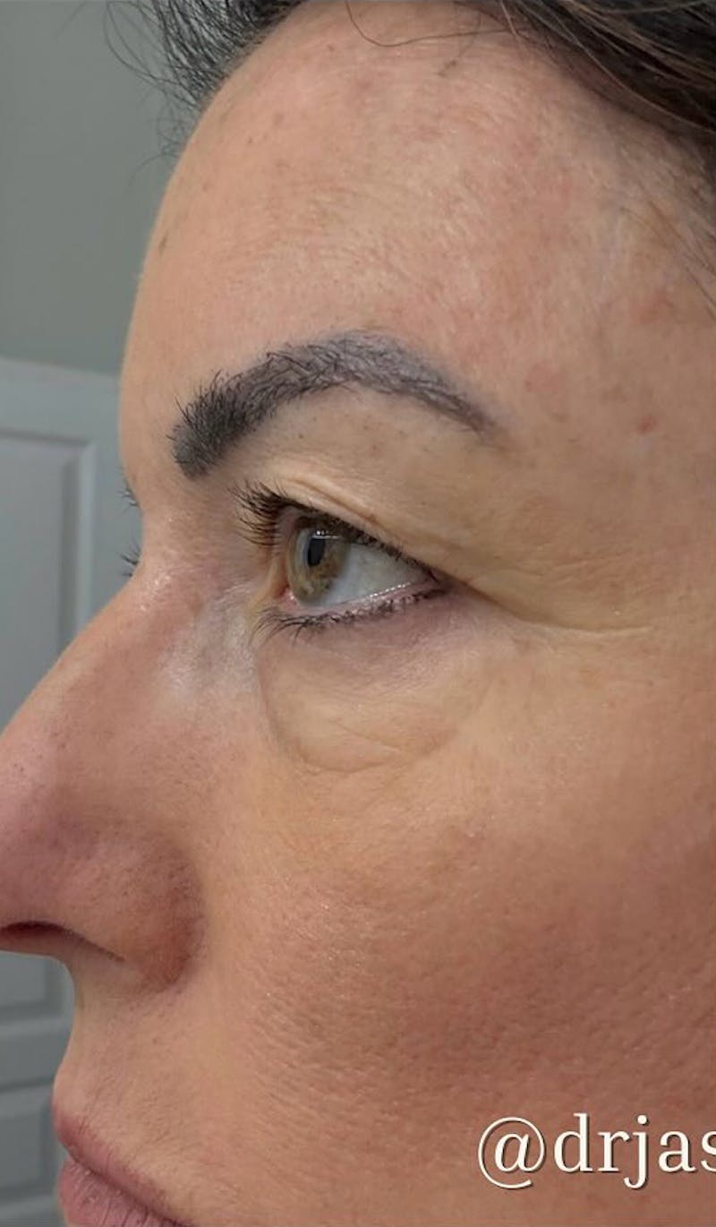 Eyelid Surgery Before & After Gallery - Patient 159271 - Image 5
