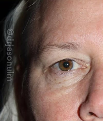 Eyelid Surgery Before & After Gallery - Patient 533027 - Image 1