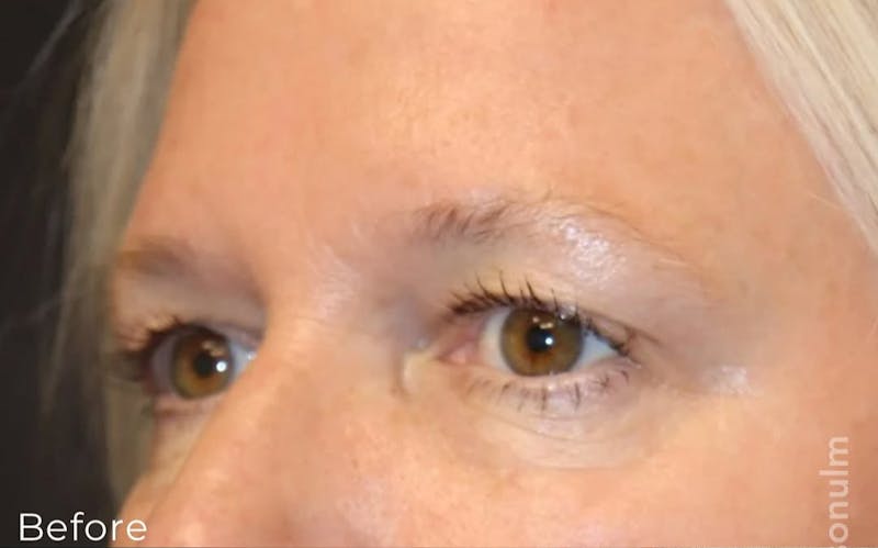 Eyelid Surgery Before & After Gallery - Patient 533027 - Image 3