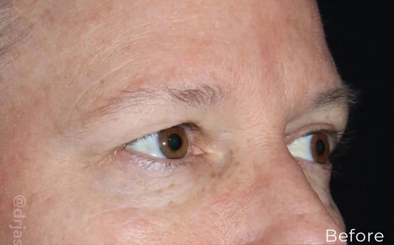 Eyelid Surgery Before & After Gallery - Patient 533027 - Image 5