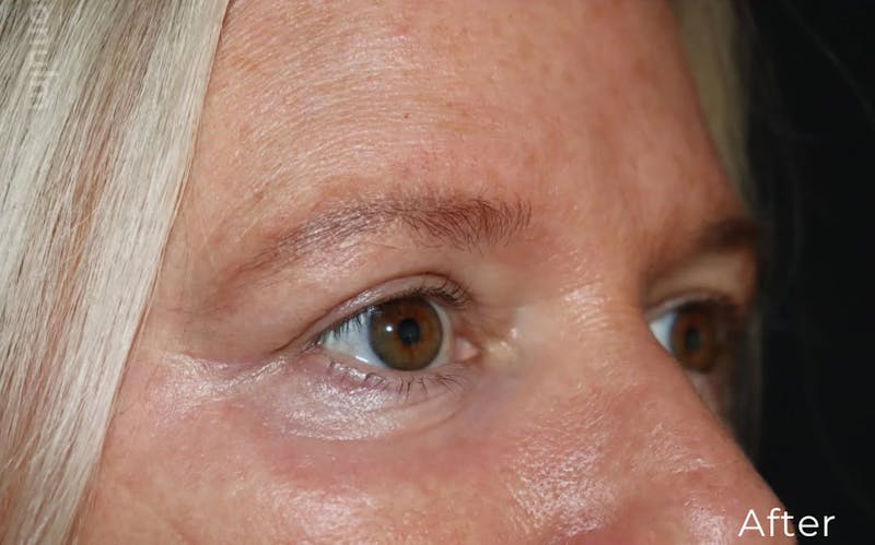 Eyelid Surgery Before & After Gallery - Patient 533027 - Image 6