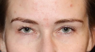 Eyelid Surgery Before & After Gallery - Patient 397731 - Image 1