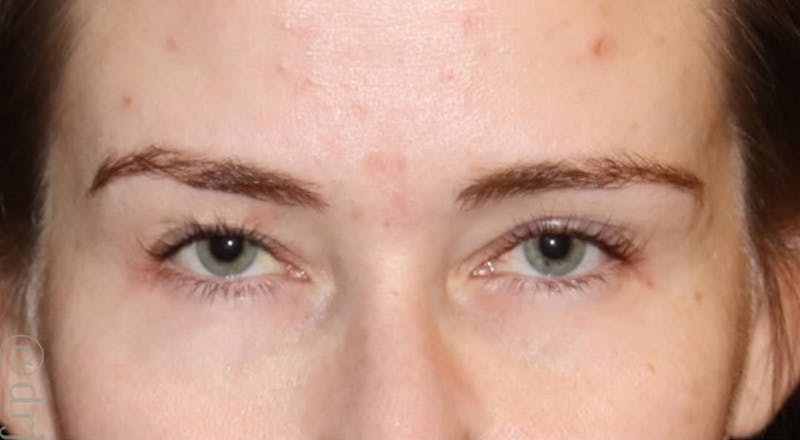 Eyelid Surgery Before & After Gallery - Patient 397731 - Image 1