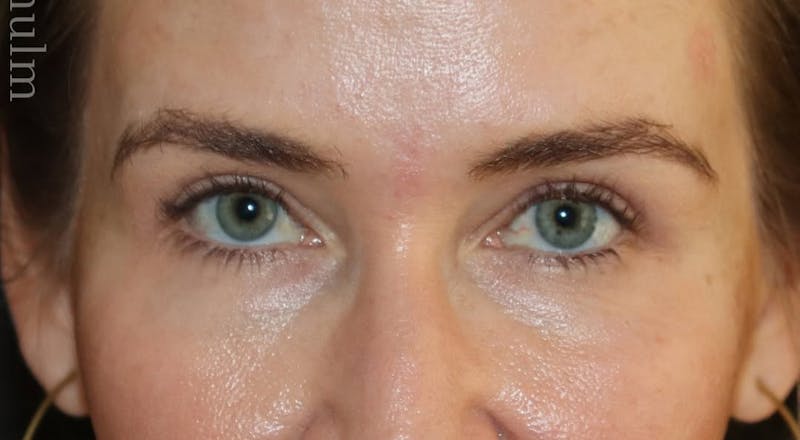 Eyelid Surgery Before & After Gallery - Patient 397731 - Image 2