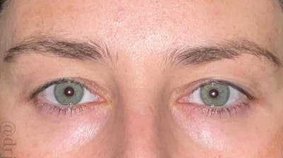 Eyelid Surgery Before & After Gallery - Patient 333204 - Image 1