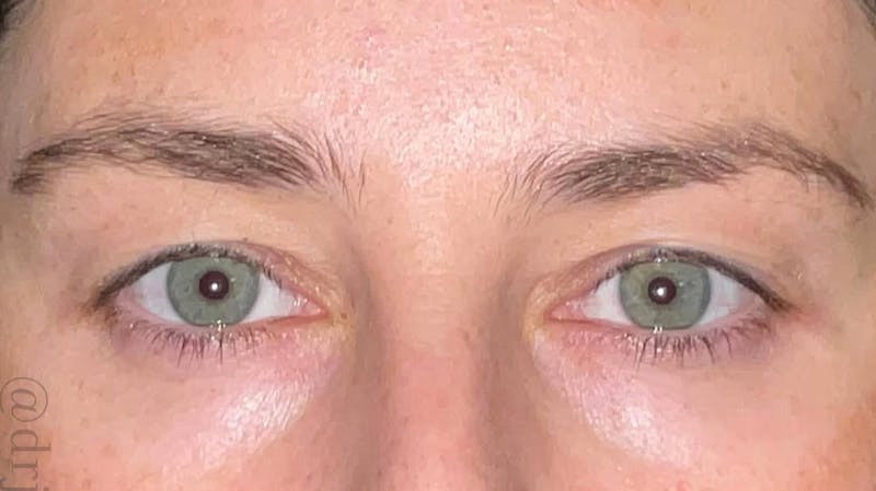 Eyelid Surgery Before & After Gallery - Patient 333204 - Image 1