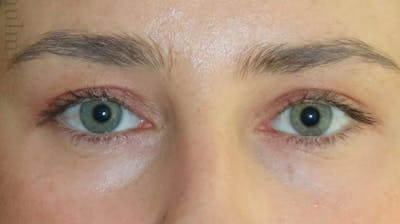 Eyelid Surgery Before & After Gallery - Patient 333204 - Image 2