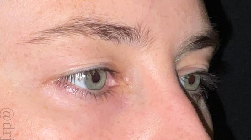 Eyelid Surgery Before & After Gallery - Patient 333204 - Image 3