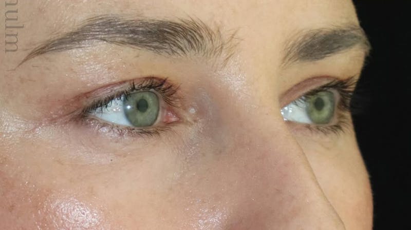 Eyelid Surgery Before & After Gallery - Patient 333204 - Image 4