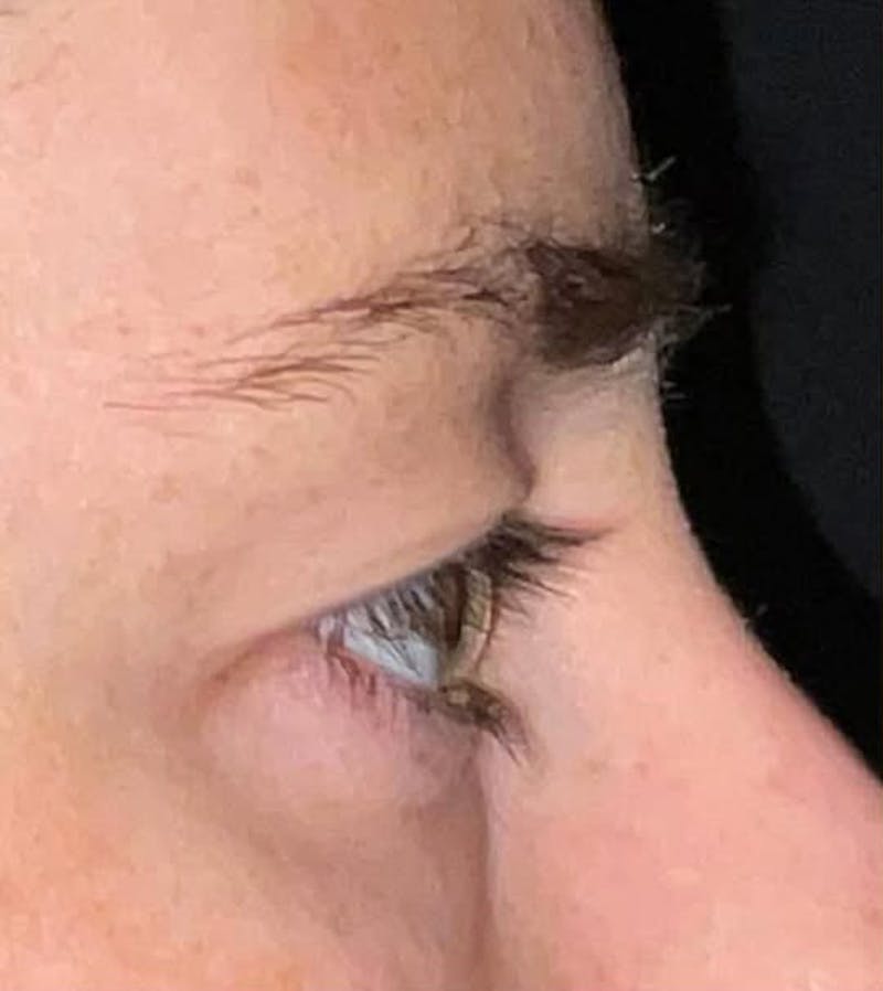 Eyelid Surgery Before & After Gallery - Patient 333204 - Image 5