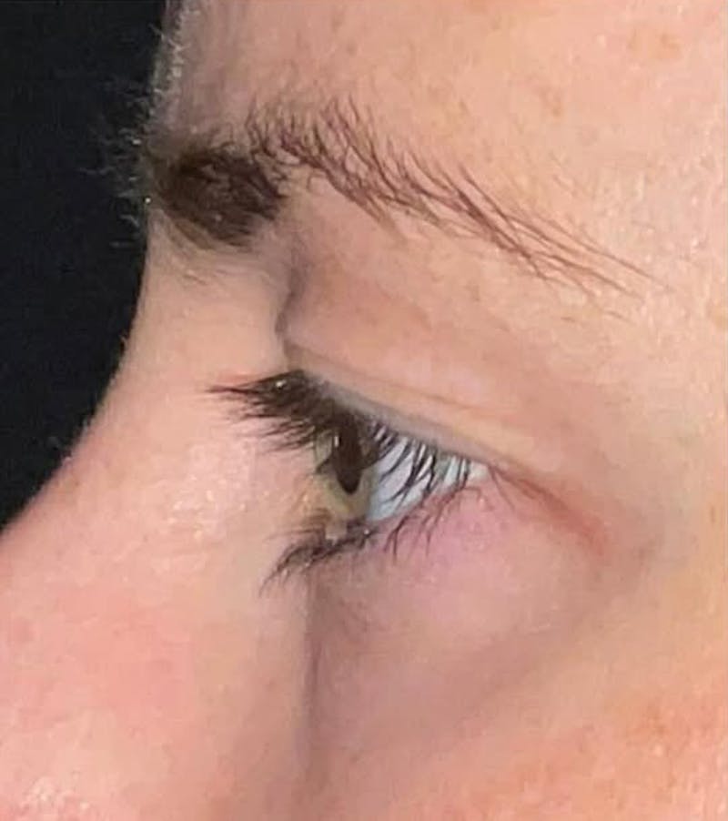 Eyelid Surgery Before & After Gallery - Patient 333204 - Image 7