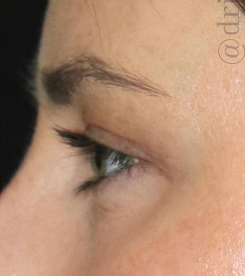 Eyelid Surgery Before & After Gallery - Patient 333204 - Image 8