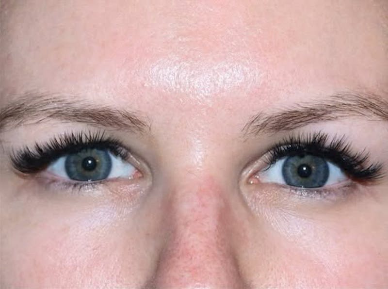 Eyelid Surgery Before & After Gallery - Patient 203562 - Image 1