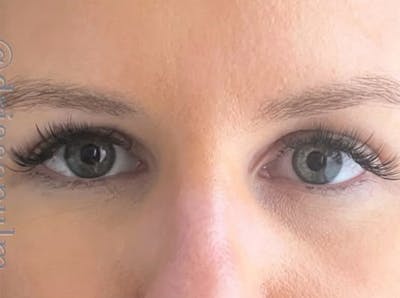 Eyelid Surgery Before & After Gallery - Patient 203562 - Image 2