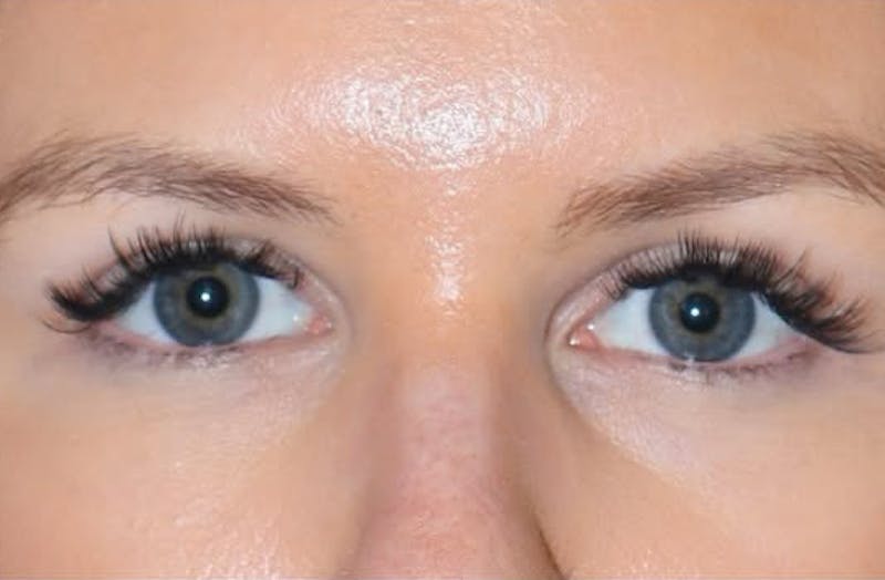 Eyelid Surgery Before & After Gallery - Patient 203562 - Image 4