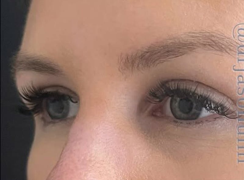 Eyelid Surgery Before & After Gallery - Patient 203562 - Image 6