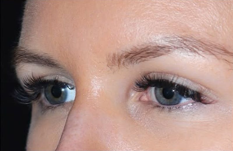Eyelid Surgery Before & After Gallery - Patient 203562 - Image 8