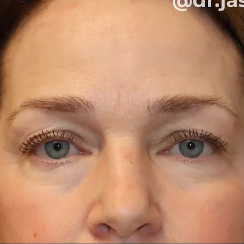 Eyelid Surgery Before & After Gallery - Patient 535294 - Image 1