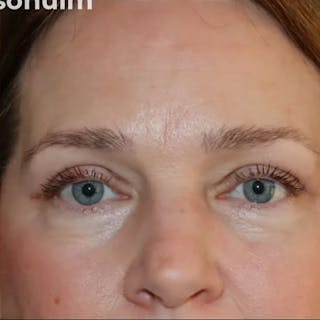 Eyelid Surgery Before & After Gallery - Patient 535294 - Image 2