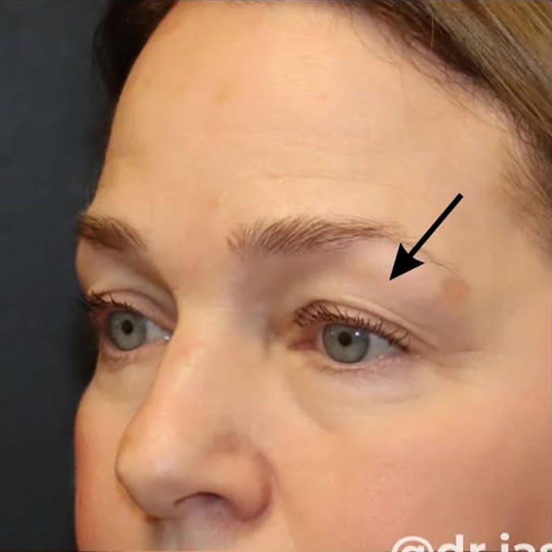 Eyelid Surgery Before & After Gallery - Patient 535294 - Image 3