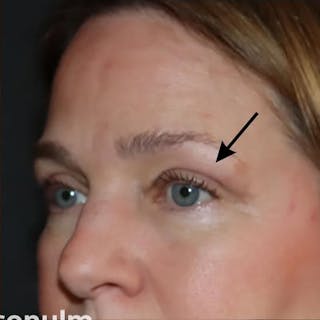 Eyelid Surgery Before & After Gallery - Patient 535294 - Image 4