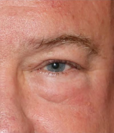 Eyelid Surgery Before & After Gallery - Patient 305133 - Image 1