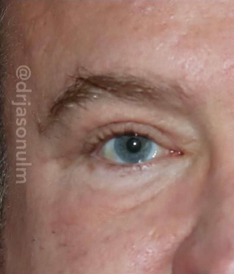 Eyelid Surgery Before & After Gallery - Patient 305133 - Image 2