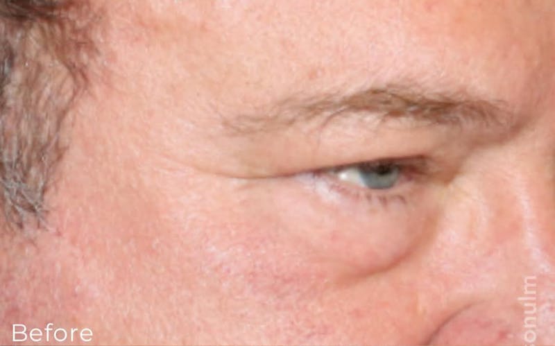 Eyelid Surgery Before & After Gallery - Patient 305133 - Image 3