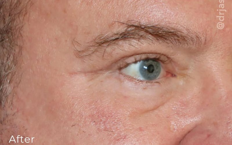 Eyelid Surgery Before & After Gallery - Patient 305133 - Image 4
