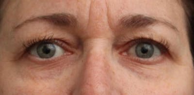 Eyelid Surgery Before & After Gallery - Patient 232480 - Image 1