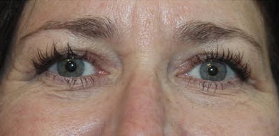 Eyelid Surgery Before & After Gallery - Patient 232480 - Image 2