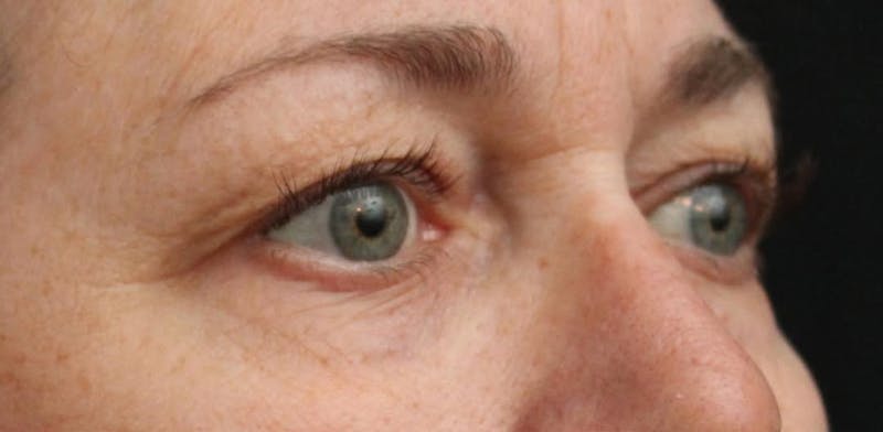 Eyelid Surgery Before & After Gallery - Patient 232480 - Image 3