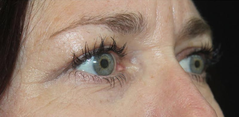 Eyelid Surgery Before & After Gallery - Patient 232480 - Image 4