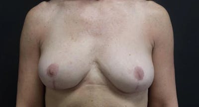 Breast Fat Transfer Before & After Gallery - Patient 157306 - Image 2