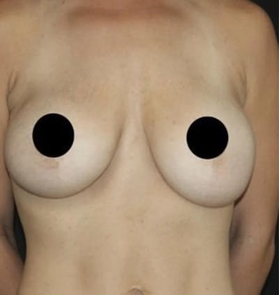 Breast Implant Exchange Before & After Gallery - Patient 346644 - Image 1