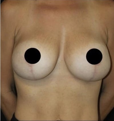 Breast Implant Exchange Before & After Gallery - Patient 346644 - Image 2