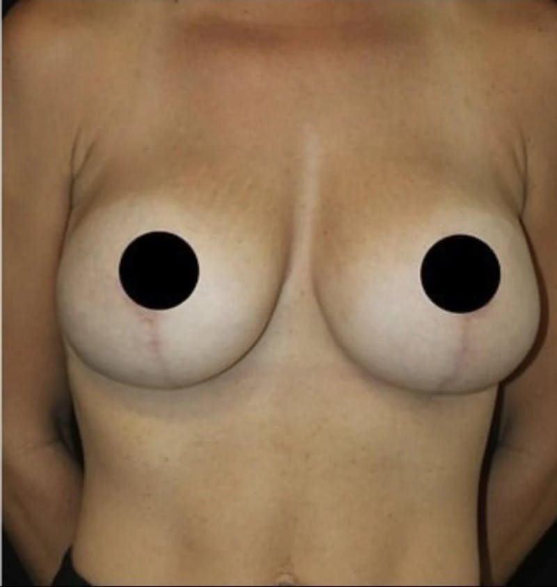 Breast Implant Exchange Before & After Gallery - Patient 346644 - Image 2