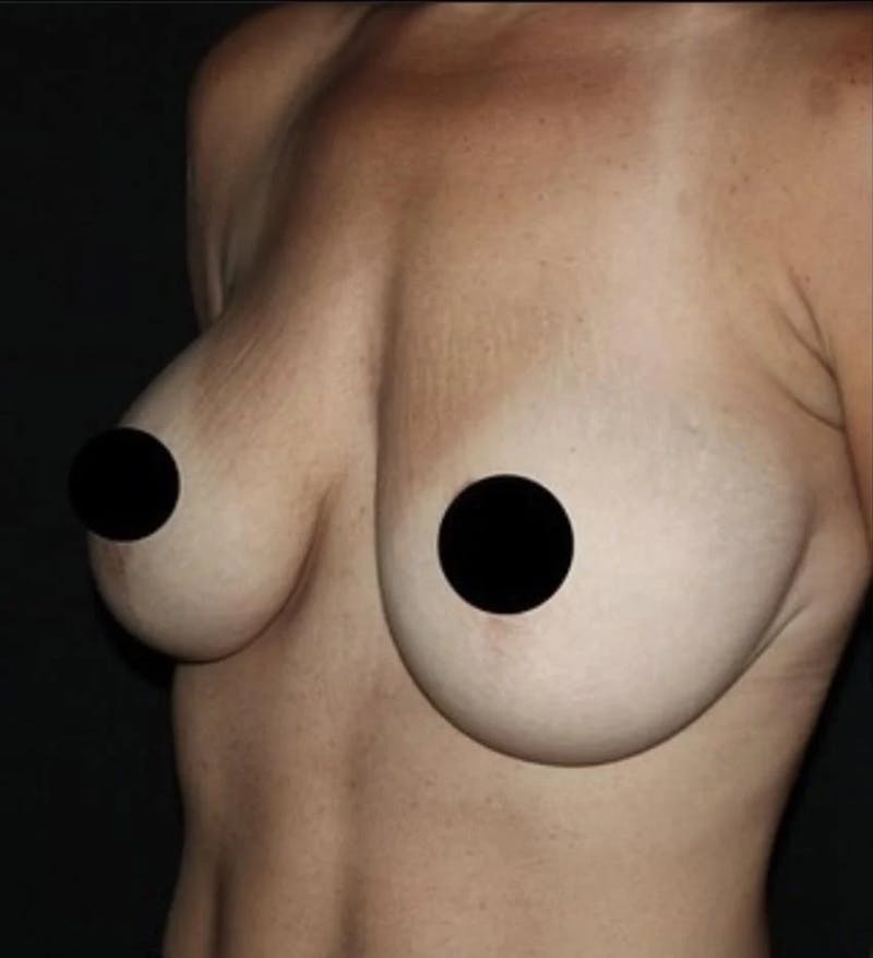 Breast Implant Exchange Before & After Gallery - Patient 346644 - Image 3