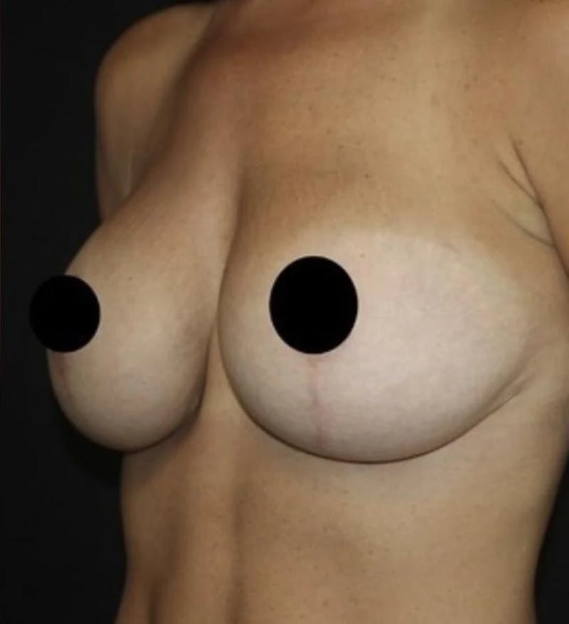 Breast Implant Exchange Before & After Gallery - Patient 346644 - Image 4