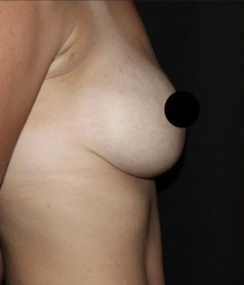 Breast Implant Exchange Before & After Gallery - Patient 346644 - Image 5