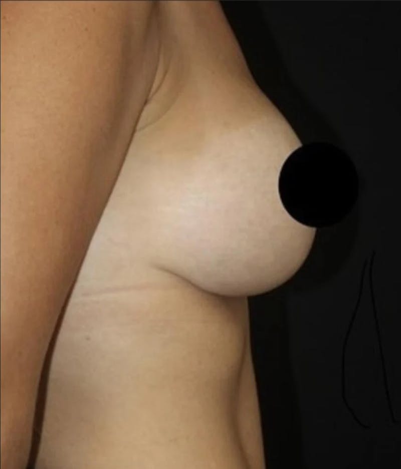 Breast Implant Exchange Before & After Gallery - Patient 346644 - Image 6