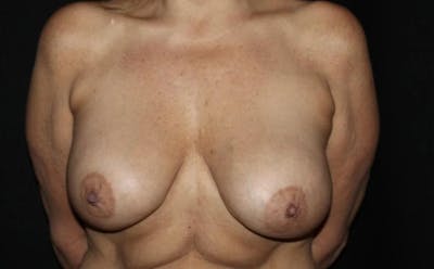 Breast Implant Exchange Before & After Gallery - Patient 212941 - Image 1