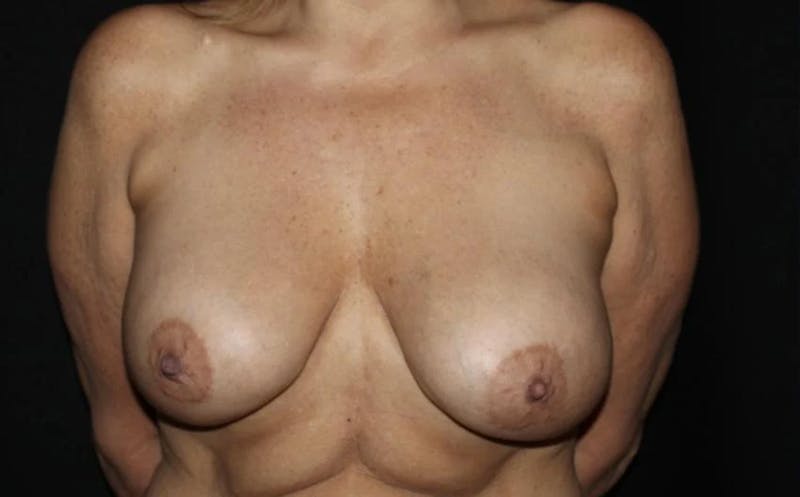 Breast Implant Exchange Before & After Gallery - Patient 212941 - Image 1