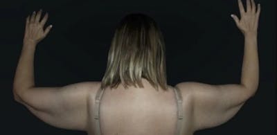 Arm Lift Before & After Gallery - Patient 408133 - Image 1